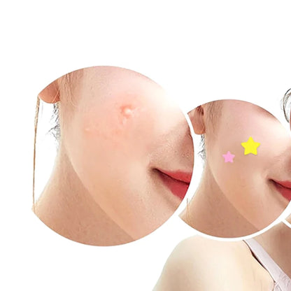 Hydrocolloid Pimple Patches — Fast-Acting Blemish Patches for Face & Body